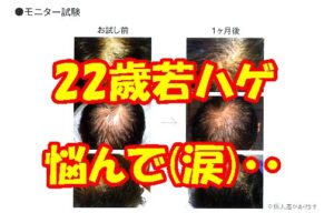 育毛お悩み・10代、20代の若ハゲ４