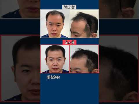 薄毛治療2ヶ月目【ホンマでっかTV⁈出演】 AGA専門医師水本理が自分の治療体験を解説