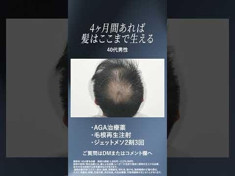 #薄毛治療 #湘南agaクリニック #ジェットメソ #毛根再生注射