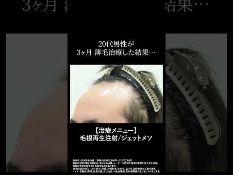 #湘南agaクリニック #薄毛治療 #毛根再生注射 #ジェットメソ