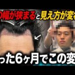 【20代薄毛】額の幅が変わると印象が激変!植毛6ヶ月のリアルな変化