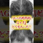 【薄毛】AGA治療の経過