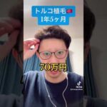 トルコ植毛🇹🇷1年5ヶ月‼️ #海外植毛 #トルコ植毛 #薄毛の味方 #フィナステリド #自毛植毛 #生え際 #aga治療 #令和の虎 #林社長 #ハゲリーマン #竹之内社長 #いしだ壱成