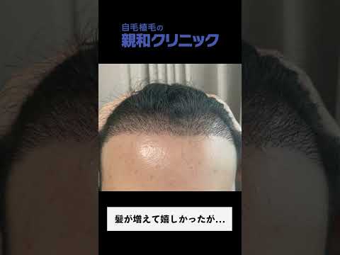 【自毛植毛】30代男性のM字の悩みが改善！！【AGA】【薄毛】#shorts