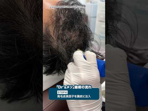 【99.4%が発毛実感】注射する薄毛治療がスゴい #shorts #aga治療 #抜け毛 #薄毛 #agaスキンクリニック