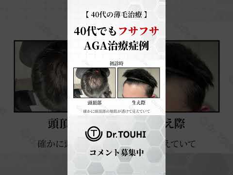 【薄毛治療】40代でもフサフサに！AGA治療症例のリアルをご紹介！