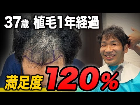 【満足度120%】植毛前は薄毛すぎた37歳の変化がスゴすぎる…！