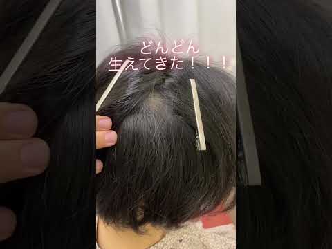 #円形脱毛症　#育毛　#鍼治療　円形脱毛症や薄毛に悩んでいる方に東京都台東区浅草橋にある鍼灸治療院BODYREMAKER が提案するRe:育毛鍼の効果　慢性的な円形脱毛症が治ります