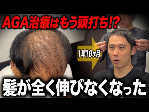 【本当に限界】AGA治療1年10ヶ月で効果の頭打ちに直面…。