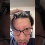 トルコ植毛に気をつけて⚠️ #薄毛の味方 #植毛 #トルコ植毛 #フィナステリド #生え際 #aga治療 #自毛植毛 #海外植毛 #ハゲリーマン #林社長 #楽しんご #いしだ壱成 #ハウスダスト