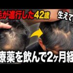 【40代薄毛】初めてAGA治療薬を飲んで2ヶ月で早速変化を実感!?