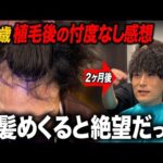 【隠れ薄毛】見た目は薄くないけど植毛2ヶ月経過した忖度なしの感想